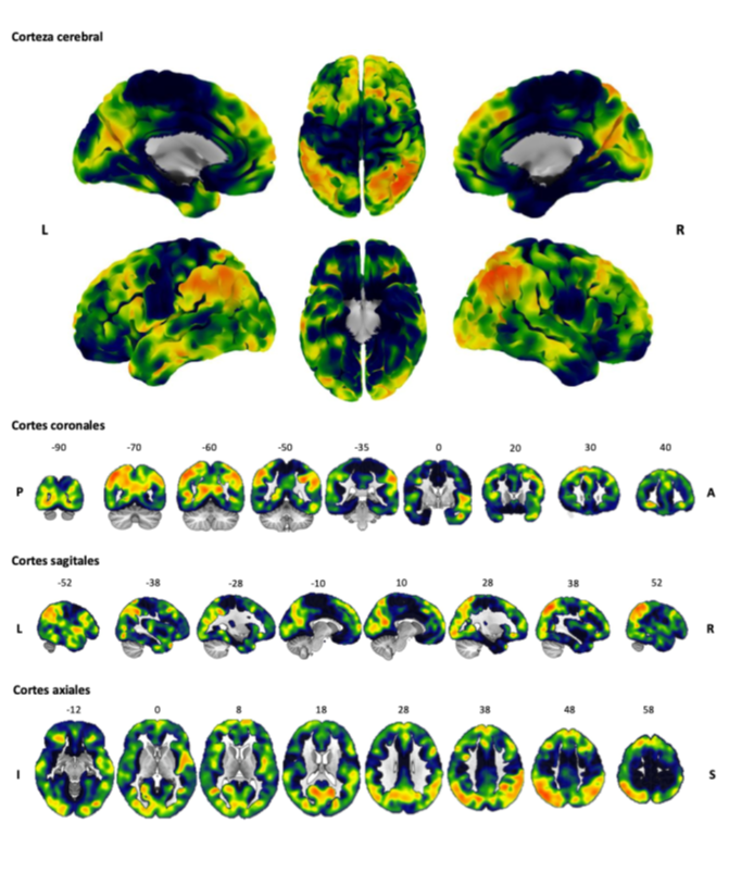 Estudios realizados en Sevilla revelan nuevos factores sobre la enfermedad de Parkinson